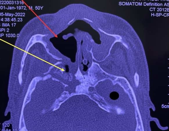 Phim X-quang chụp xương vùng hàm mặt bệnh nhân bị hoại tử. Ảnh: Bệnh viện Chợ Rẫy