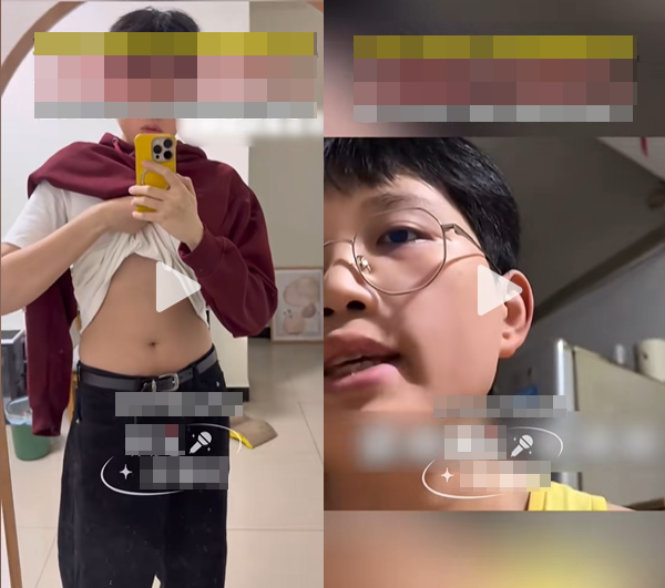 Nam thanh niên 32 tuổi bỗng "dậy thì", phát triển ngực như phụ nữ, bác sĩ sốc khi nồng độ hormone nam chỉ dưới 0.1 - Ảnh 1.